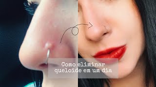 Como acabar com a queloide do piercing  Sharon Mel [upl. by Oiredised]