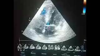 RA thrombus protruding into RV [upl. by Campman]