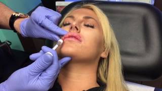 Microdroplet lip injection Using Restylane Juvederm [upl. by Nryhtak]