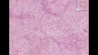 Histopathology Liver  Fatty change [upl. by Clover]