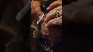 Disgusting Self Removal of Pilar Cyst Sac [upl. by Ydnak]