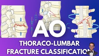 AO Classification Thoracolumbar Fractures [upl. by Spanos197]