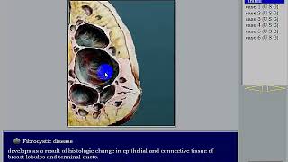 Breast Ultrasound Part 4 Fibrocystic Disease of the Breast [upl. by Lorry]