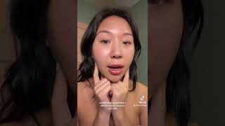 Botox in my masseter muscle to slim my face [upl. by Sreip]