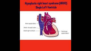 Hypoplastic Right Heart Syndrome HRHS Single Left Ventricle [upl. by Mientao]