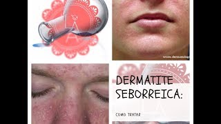 Dermatite Seborreica Facial Como Tratar [upl. by Barnett]