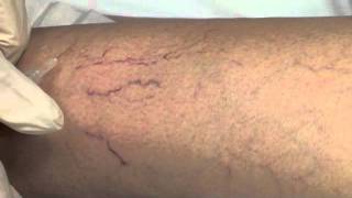 Spider Vein Sclerotherapy [upl. by Akemit]