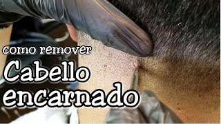 Como remover cabello encarnado [upl. by Eirallih101]