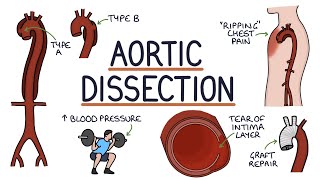 Understanding Aortic Dissection [upl. by Aihsekan128]