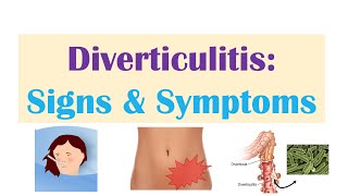 Diverticulitis Signs amp Symptoms And Why They Occur [upl. by Akenit]