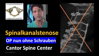 Spinalkanalstenose  neue Operationsmethode ohne Versteifung der Wirbel [upl. by Margette]