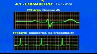 INTERPRETACION DEL ELECTROCARDIOGRAMA [upl. by Aniweta]