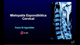 MIELOPATIA ESPONDILÓTICA CERVICAL [upl. by Trudi]