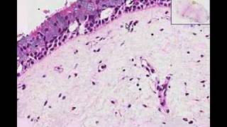 Histopathology Nose Nasal polyp [upl. by Brianne883]