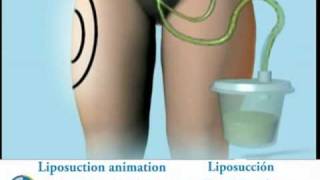 Liposuction Animation Liposucción  WLS [upl. by Mihalco]