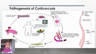 Cysticercosis [upl. by Imhskal868]