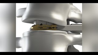 DepuySynthes X PAC Expandable Interbody Cage and UNLEASH TLIF Procedure Animation [upl. by Aramo]