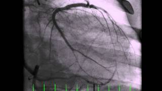 Anomalous left main coronary artery originating from right coronary cusp [upl. by Goltz]