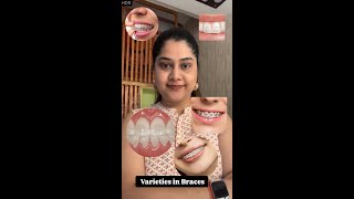 What are different types of braces metal ceramicinvisiblealignersself ligating bracesytvideo [upl. by Eirual]