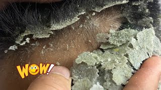 Get Rid Of Scalp Dandruff With The Ultimate Scratching Technique [upl. by Aeht571]