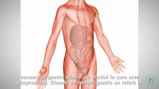 Cancerul gastric [upl. by Margi]