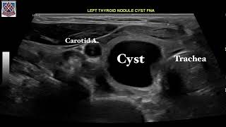 Thyroid cystic nodule treatment by Sean Nikravan MD FACE Thyroid Institute [upl. by Meredi]