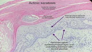 actinic keratosis [upl. by Alvina251]