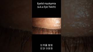 눈꺼풀이 파르르 떨려요 눈떨림 눈꺼풀 떨림 Eyelid myokymia Eye twitch shorts [upl. by Ecinue]