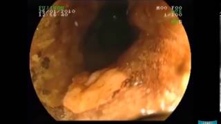 Advanced Endoscopic Imaging for Characterization of Heterotopic Gastric Mucosa in the Esophagus [upl. by Geilich985]