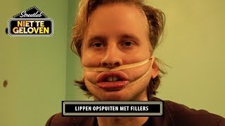 STREETLAB Lippen opspuiten met fillers [upl. by Eeldarb]