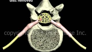 Lumbar Discectomy disc removal and Fusion  Narration and Animation by Cal Shipley MD [upl. by Elenahc]