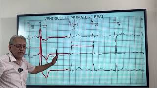 VENTRICULAR ECTOPICS  VENTRICULAR PREMATURE BEATS HOW TO DIAGNOSE ON ECG [upl. by Naarah]