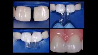 Bioclear  Diastema Closure [upl. by Aiuoqes]