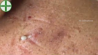 Deep Whiteheads Removal On Face  Acne Treatment 171112 [upl. by Samid]