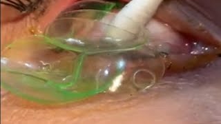 Doctor removes 23 contact lenses from patients eye [upl. by Fleurette]