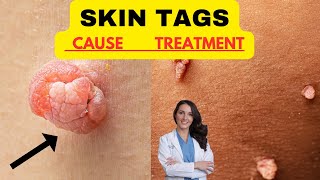 SKIN TAGS CAUSE AND NATURAL TREATMENTS Link Between Diabetes Insulin Resistance and Skin Tags [upl. by Darleen465]