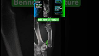 Thumb Fracture  Bennett’s fracture shorts radiology xray trauma [upl. by Eicaj713]