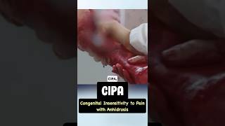 CIPA  insensitivity to pain  usmle neetpg anesthesia pediatrics [upl. by Bailar12]