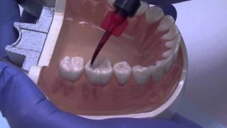 Dental Sealants  Moms Everyday May 2013 [upl. by Agata]