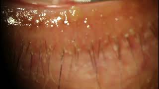 Meibomian Cyst Popped with Needle [upl. by Fonville]