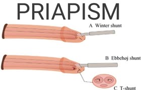 Priapism  IntroductionIncidenceTypes CausesPathophysiologySymptomsManagementComplications [upl. by Tullius]