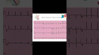 Identificación y Tratamiento de Taquiarritmias Flúter Taquicardia Atrial y Fibrilación Auricular [upl. by Siana932]