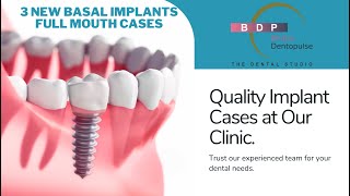 3 new cases of basal implants full mouth done at our clinic dentalimplants basalimplants [upl. by Okiruy520]