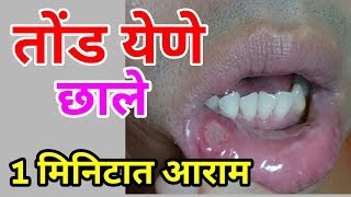 तोंड येणे 1 मिनिटात आराम घरगुती उपाय Tond yene Gharguti upay in Marathi  Mouth Ulcer Home Remedy [upl. by Alios278]