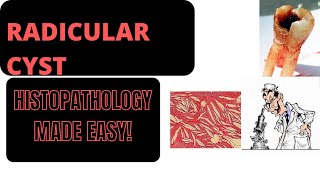 RADICULAR CYST HISTOPATHOLOGY PART 2 I ORAL PATHOLOGY [upl. by Zil234]