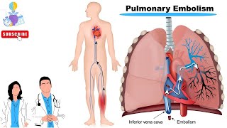 جلطات الشرايين الرئوية pulmonary Embolism [upl. by Rawdan166]