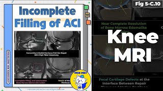 Fig 5C10 Incomplete Filling of Autologous Chondrocyte Implantation [upl. by Inalem]