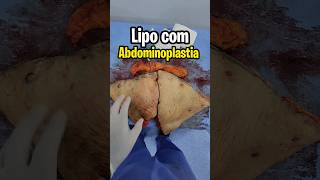 TIROU 😱 18KG PELE NA ABDOMINOPLASTIA cirurgiaplastica abdominoplastia lipohd drvalterhugo [upl. by Clementia]