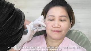 JUVEDERM SKINVIVE COLLAGEN SKIN BOOSTER [upl. by Duthie166]