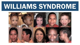 Williams Syndrome  Williams–Beuren syndrome [upl. by Meggie]